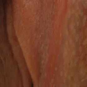 plamki fordyce'a wargi sromowe