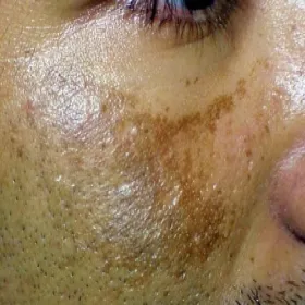 plamy na skórze zdjęcia