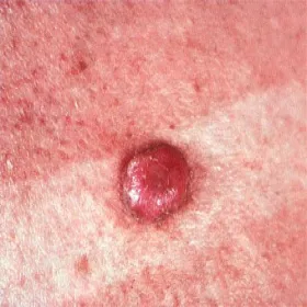 podrażniony włókniak