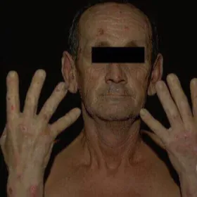 porfiria skórna późna zdjęcia chorych