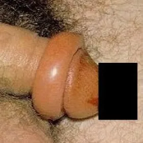 powiększony napletek