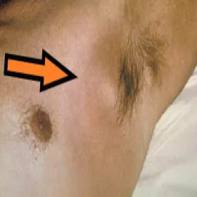 powiększony węzeł chłonny pod pachą