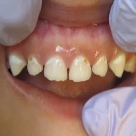 próchnica butelkowa u dzieci objawy