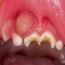 próchnica butelkowa u dziecka karmionego piersią