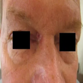 rak podstawnokomórkowy skóry okolice oko