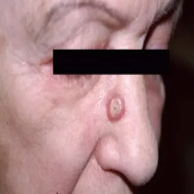 rak podstawnokomórkowy