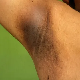 rogowacenie ciemne zdjęcia