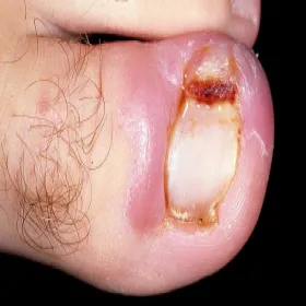 ropiejąca rana przy paznokciu