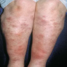 rumień guzowaty w chorobie crohna