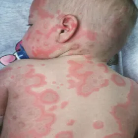 rumień wielopostaciowy u niemowlaka