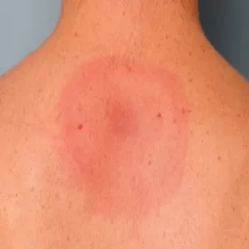 rumieniec po kleszczu na plecach