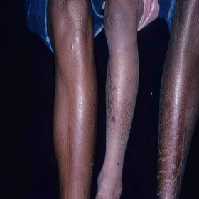 rybia łuska na nogach