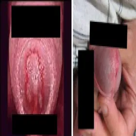 rzęsistkowica u mężczyzn