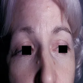 rzadkie brwi łysienie plackowate