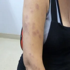 sporotrychoza limfatyczno-skórna