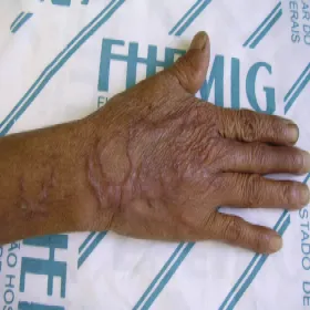 sporotrychoza na dłoni