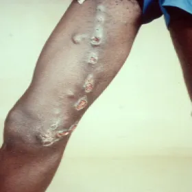 sporotrychoza rozsiana 