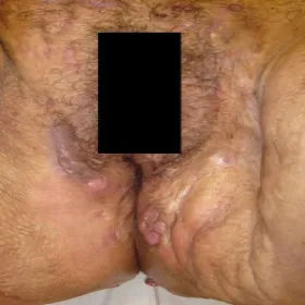 stan zapalny okolic intymnych ropne zapalenie apokrynowych gruczołów potowych