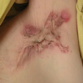 stan zapalny pod pachami trądzik odwrócony