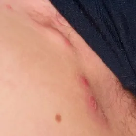 stan zapalny w pachwinie