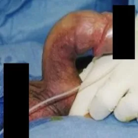 stwardnienie ciał jamistych prącia