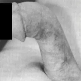 stwardnienie plastyczne prącia