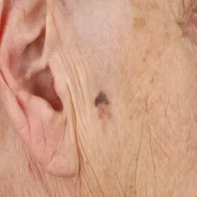 superficial spreading melanoma
