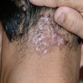 swędzące zgrubienia na głowie