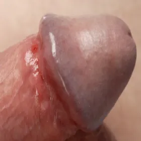 syfilis objaw na penisie