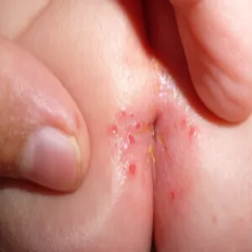 szczelina odbytu u dzieci