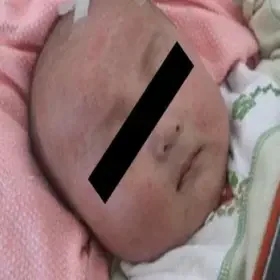 szkarlatyna u niemowlaka na twarzy