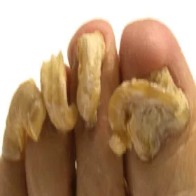 szponowatość paznokci 