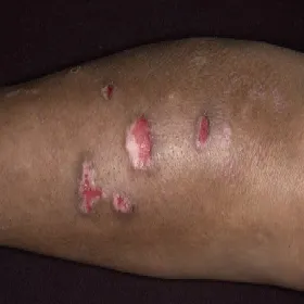 toczeń rumieniowaty na rękach