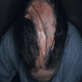 toczeń rumieniowaty na skórze głowy