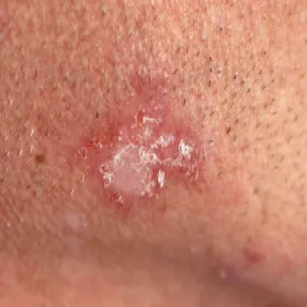 toczeń rumieniowaty objawy skórne