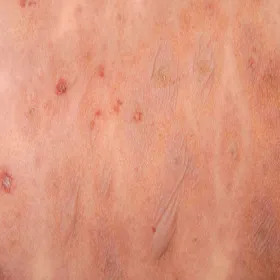 toksyczna martwica rozpływna naskórka zdjęcie