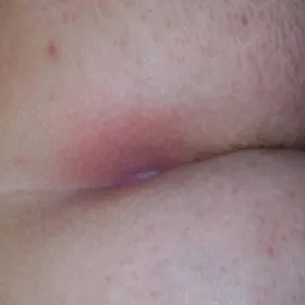 torbiel włosowa jak wygląda