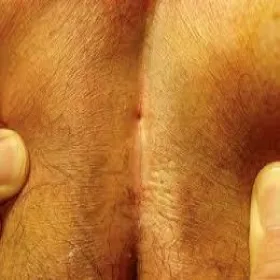 Torbiel włosowa kości ogonowej 