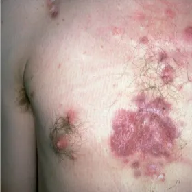 trądzik skupiony blizny