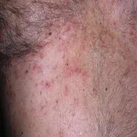transient acantholytic dermatosis