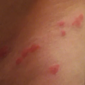 ugryzienie wszy zdjęcia