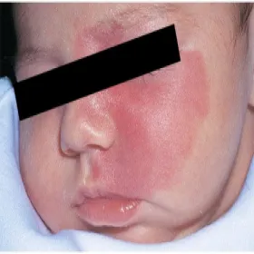 uszczypnięcie bociana czerwone znamię