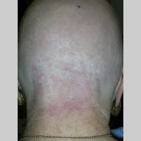 uszczypnięcie bociana u dorosłych 