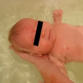 uszczypnięcie bociana u noworodka