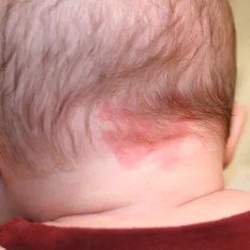 uszczypnięcie bociana z tylu głowy