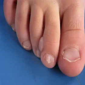 włókniak dziecięcy