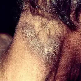 witamina pp niedobór objawy