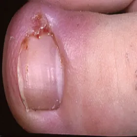 wrastający paznokieć stan zapalny