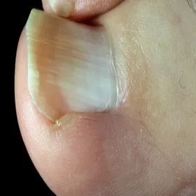 wrastający paznokieć