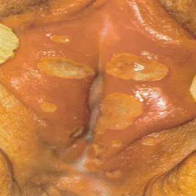 wrzód weneryczny szankier warg sromowych